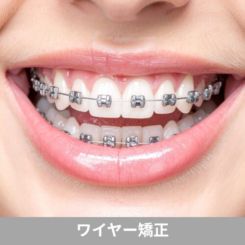 ワイヤー矯正